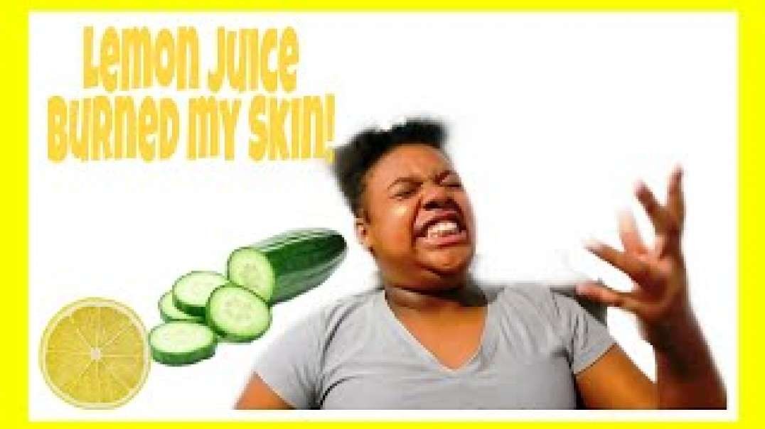 Epic Fail!! Trying to get Rid of Acne Naturally Using Lemon juice and Cucumbers