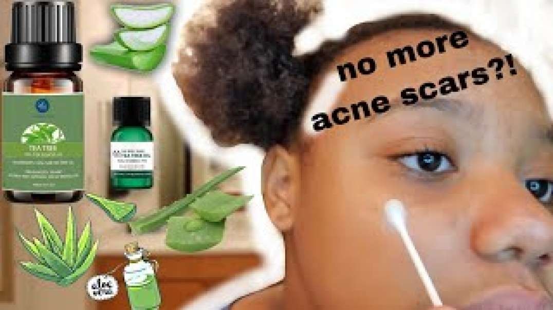 ⁣Getting Rid of Acne Scars Using Tea Tree Oil and Aloe Vera | Vlogtober Day 1