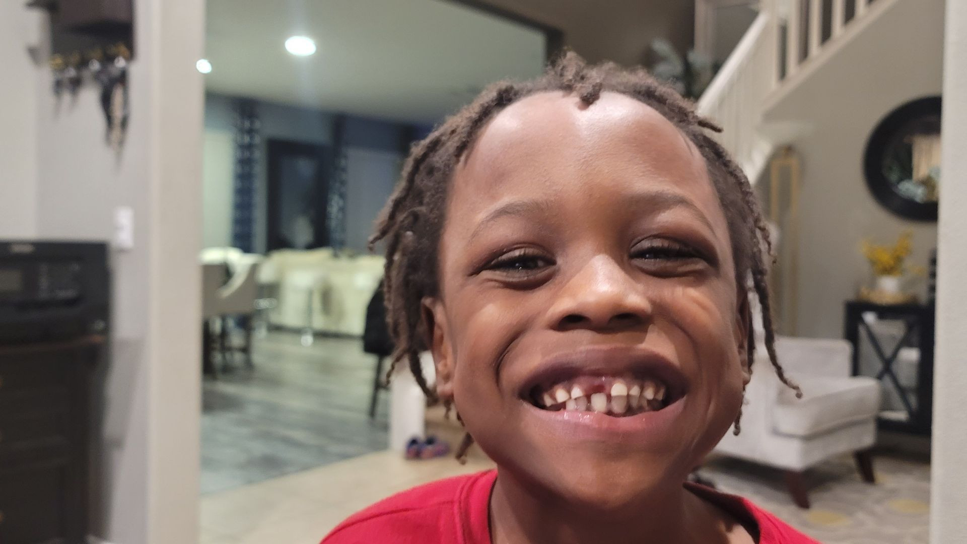 Miracle Baby Josiah's front tooth falls out